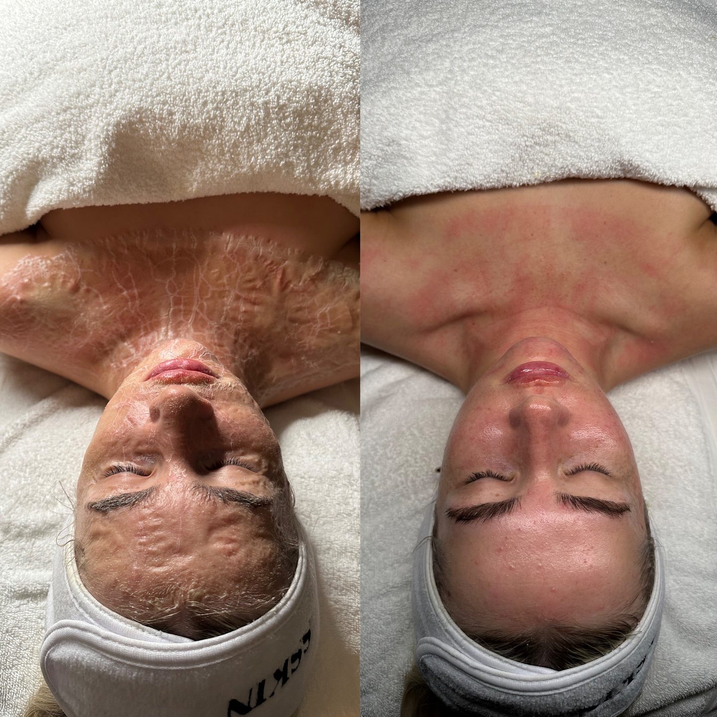 The Facial Everyone’s Talking About: DMK Enzyme Therapy